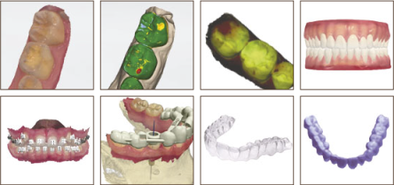 escaner_intraoral_minis